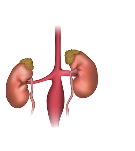 Chirurgie Aorte Abdominale / Anévrisme aorte abdominale